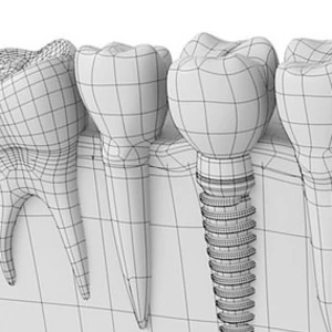 Implanologie mit 3D CT Planung