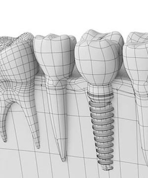 Implantálás 3D tervezéssel